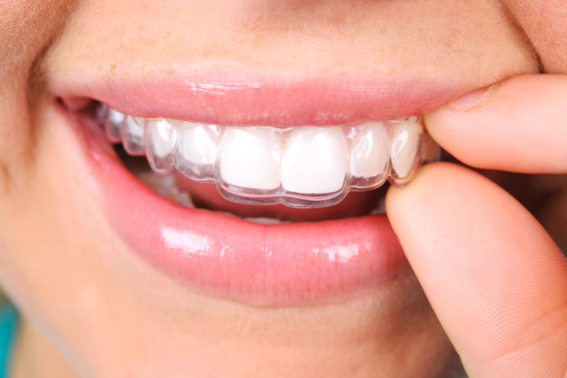 woman putting in clear removable retainer