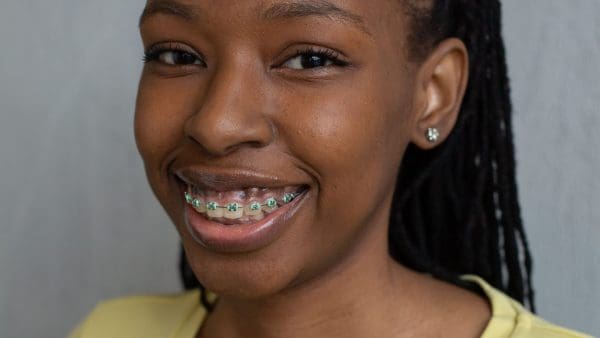 Young woman smiling with metal braces and colored bands, the parts that can pick up braces stains