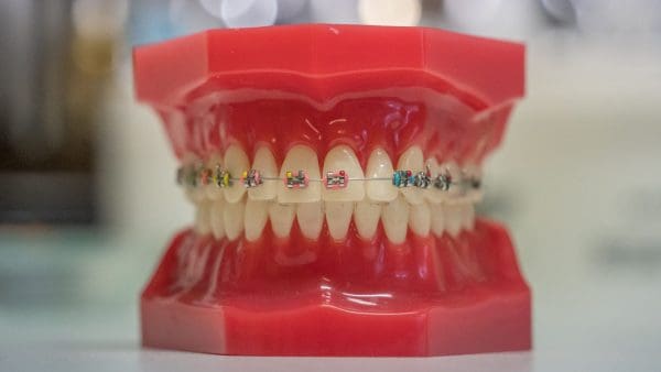 Teeth model with brackets on both arches, showing how braces line up a crossbite