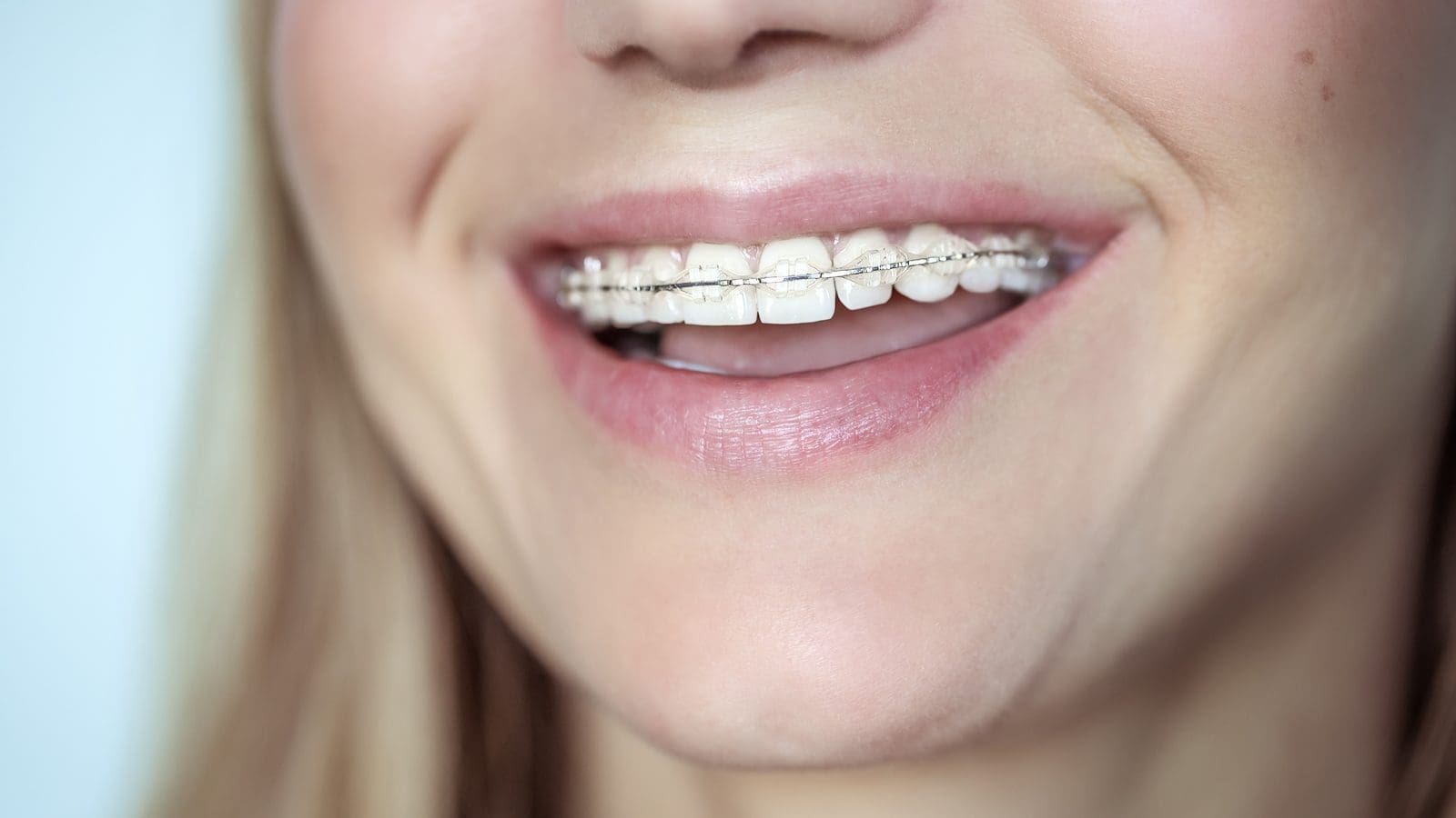 Smiling woman with clear ceramic brackets, the tooth-colored look people want from Damon clear braces
