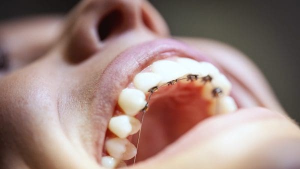 Close view of brackets bonded to the back of the upper teeth, the hidden setup behind lingual braces cost