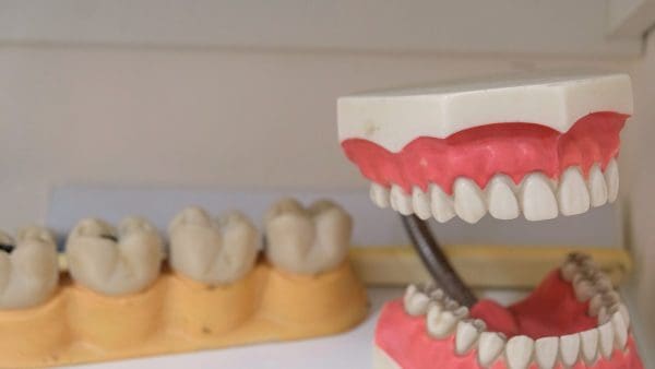 Teeth model beside plaster casts, the records used to compare an overbite before and after braces