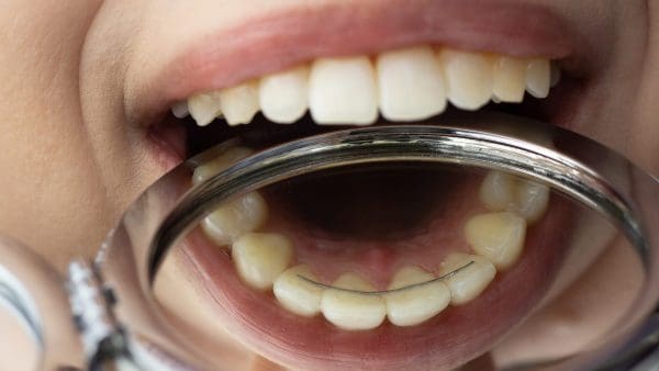 Lower front teeth seen in a dental mirror with a thin wire bonded behind them, how a permanent retainer works